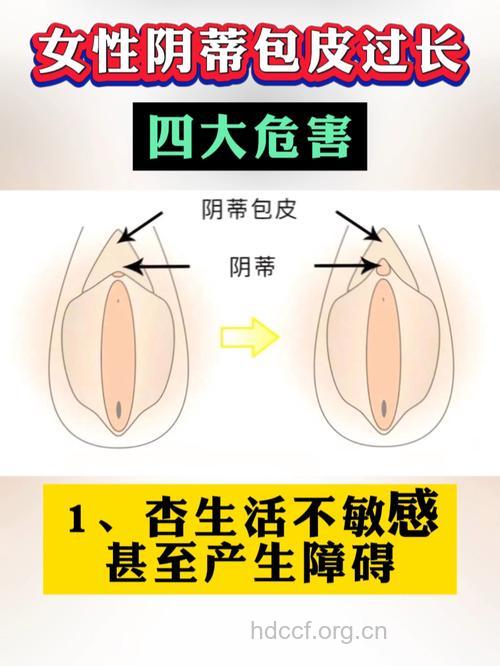 男性包皮与女人妇科病的关系