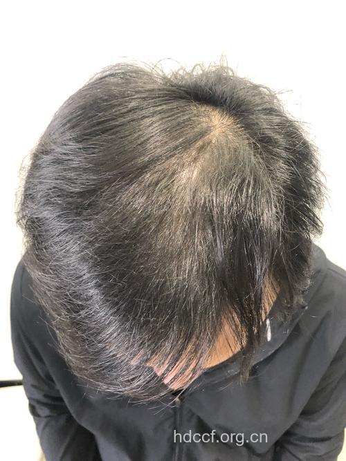 男人脱发会有哪些早期症状