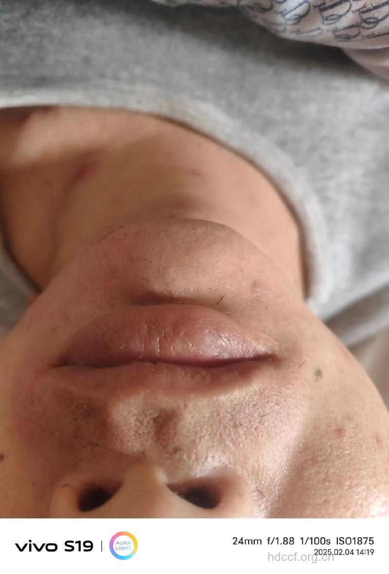 用手拔胡须可能危及生命