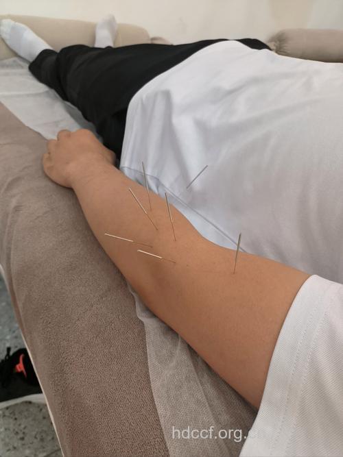 男性更年期综合征别慌张 试试中医针灸