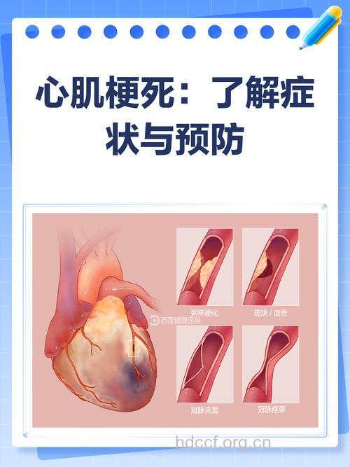 心肌梗塞型冠心病是怎么样的