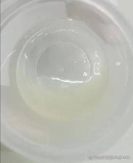 无精症病人的精液特征