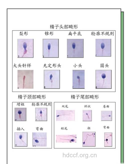 畸形精子是怎么形成的