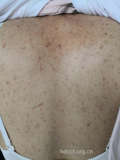 毛囊炎的早期症状表现