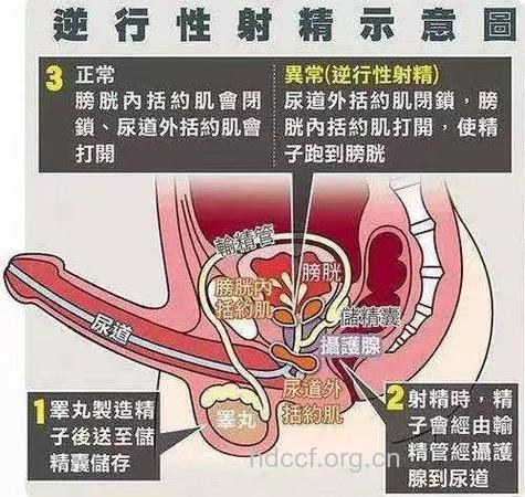 哪些外生殖器原因导致不育