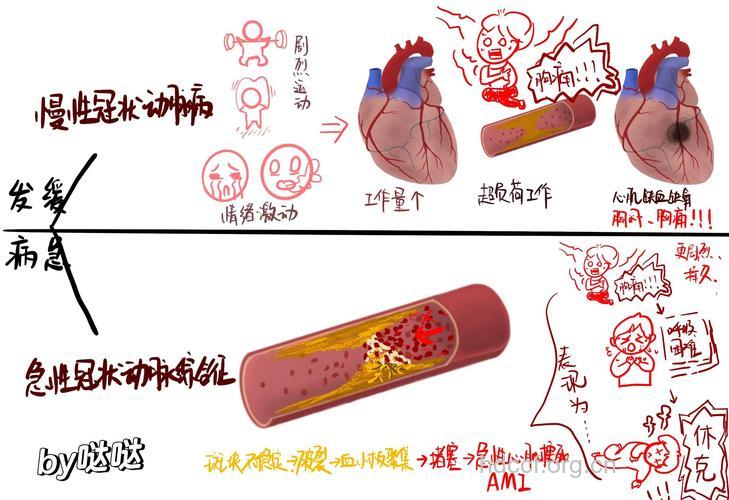 冠心病的发生与什么有关呢