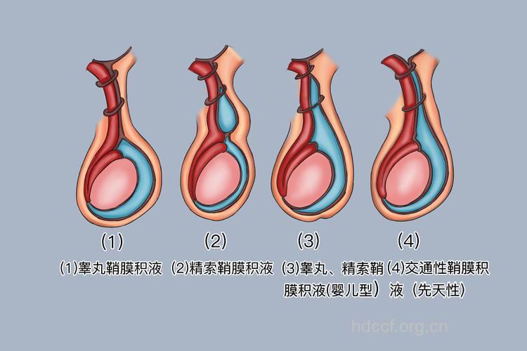 男性鞘膜积液与不育