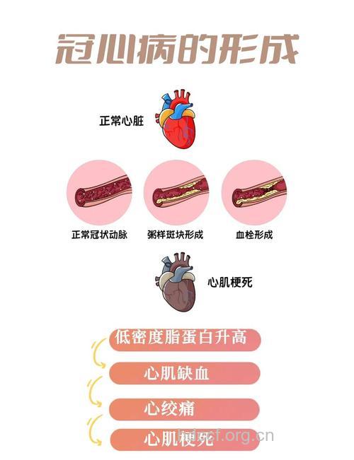 冠心病的因素具体有哪些