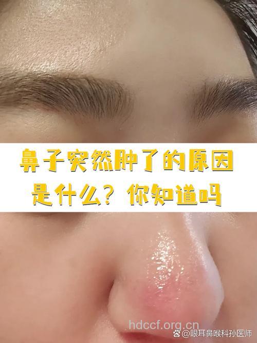 鼻尖肿大是冠心病的症状吗