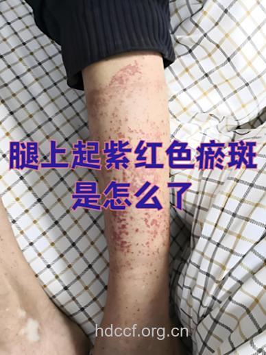 男人腿上有红血丝是怎么回事