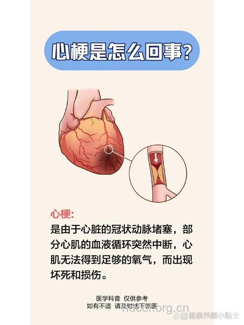 什么现象是心梗微信号