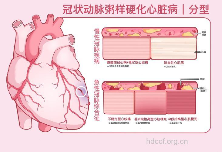 西医把冠心病分为几种类型