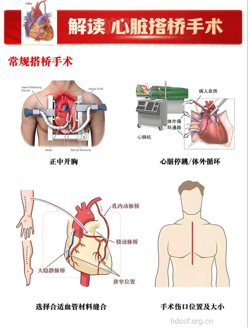 七种冠心病非手术不可