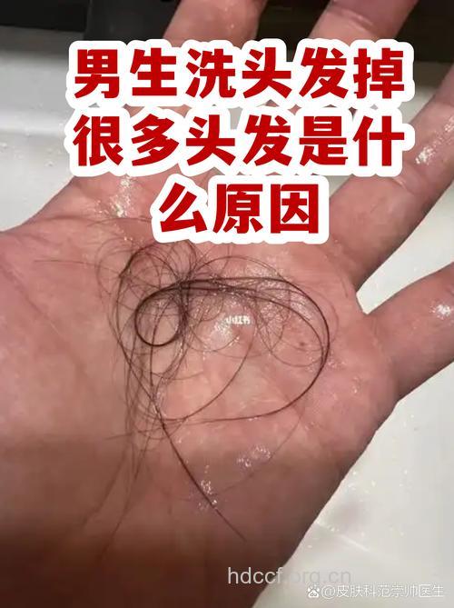 男人脱发可能是洗出来的