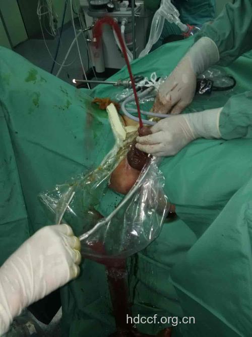 前列腺增生的手术方法是什么