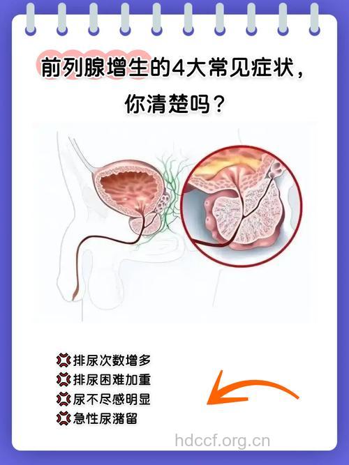 七大前列腺增生症状 四个常见治疗方法
