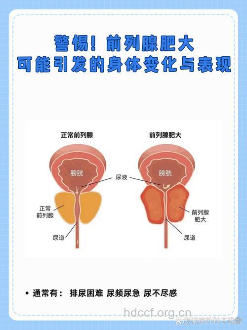 七大信号预示前列腺增生肥大