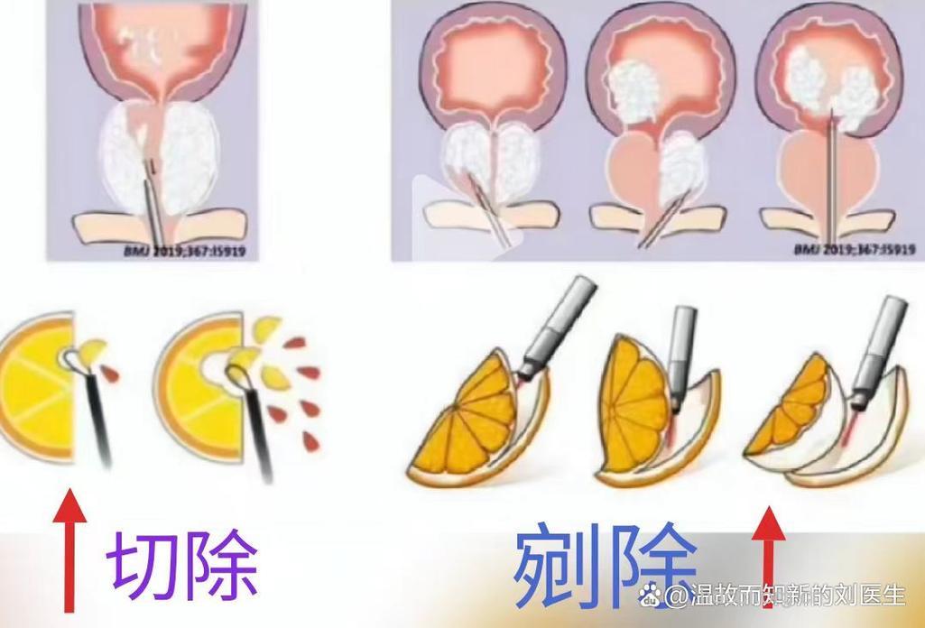 前列腺增生的手术治疗法