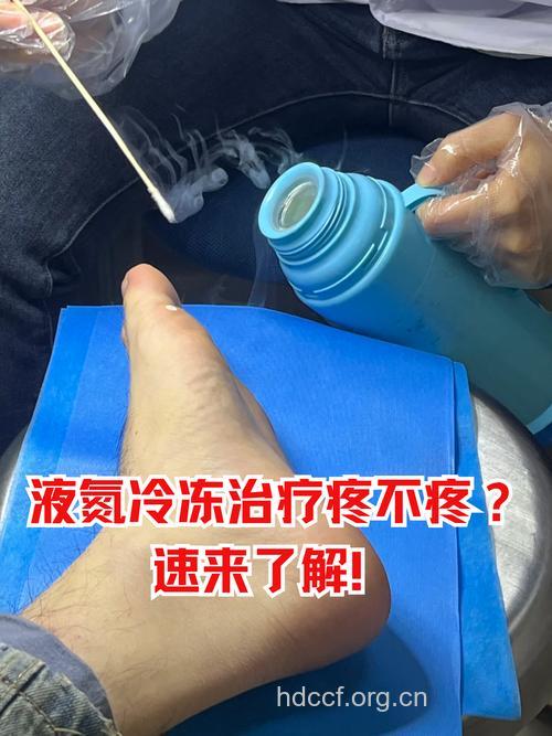 冷冻疗法可以治好前列腺增生吗