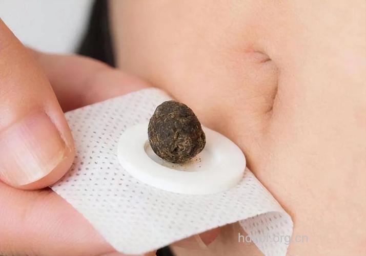 药物敷脐治疗前列腺增生