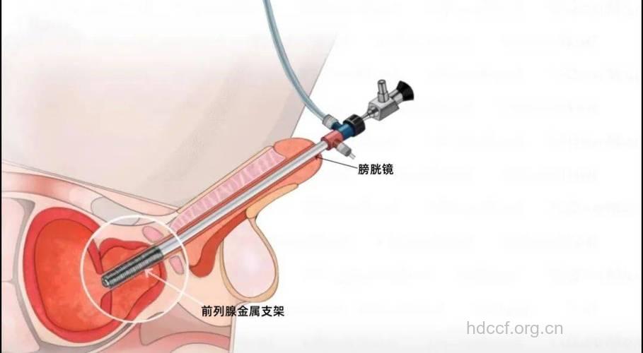 前列腺增生的尿道内支架治疗法