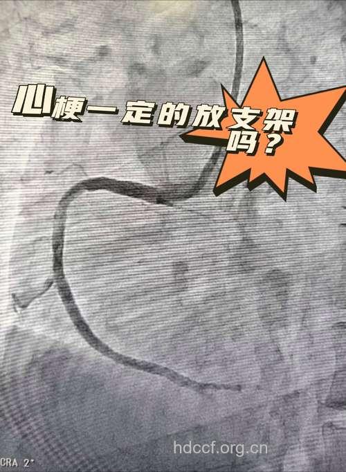 糖尿病病人能否做支架？