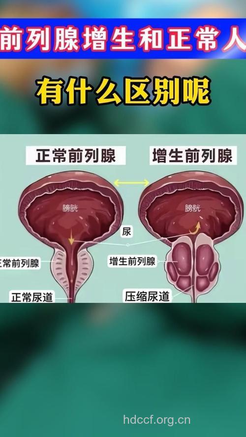 专家告诉你什么是前列腺增生