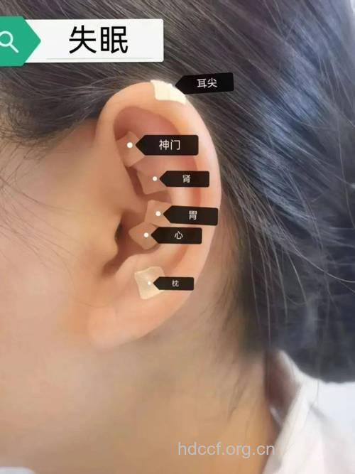 耳穴按压止住心绞痛