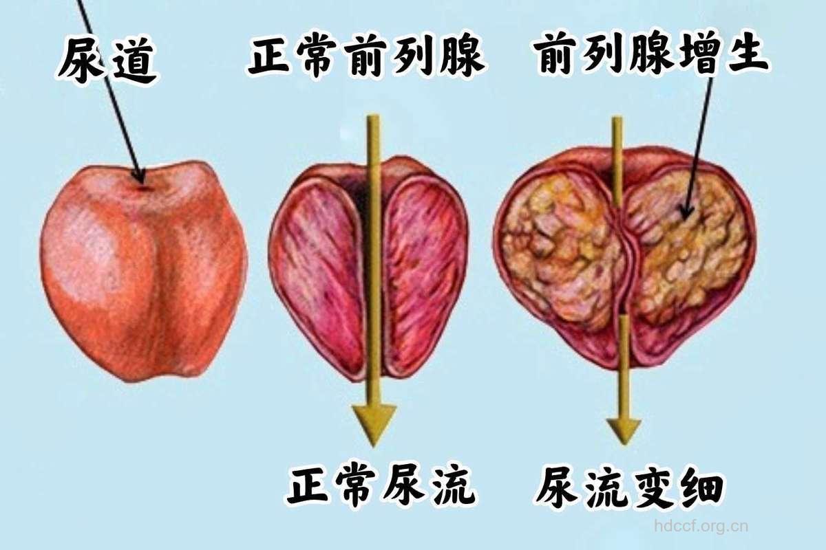 前列腺增生有哪些类型