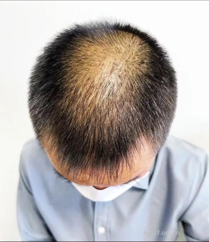 中年男人头发稀疏怎么办