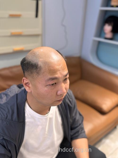 男人“头”等大事-脱发