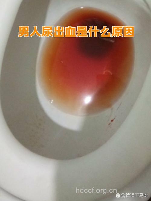 前列腺增生患者尿血不用太紧张