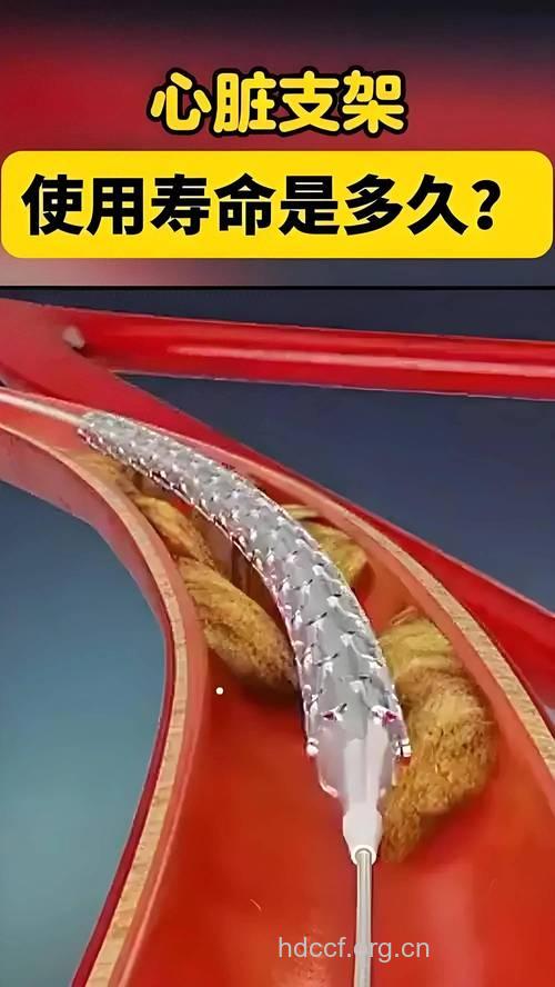 心脏支架想好了再放