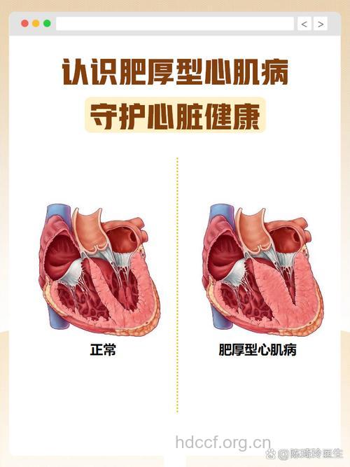 什么是心肌病