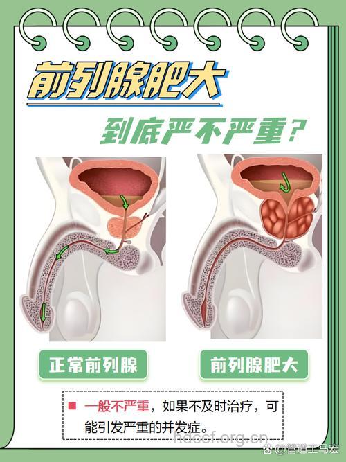 前列腺肥大对男性有什么危害