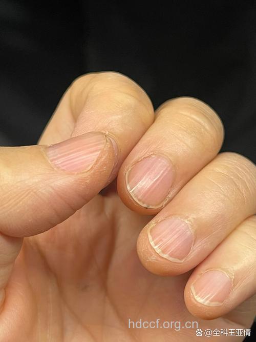 男性指甲竖条纹须当心
