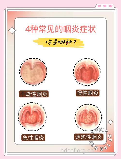 严重时咽炎的症状主要是什么呢