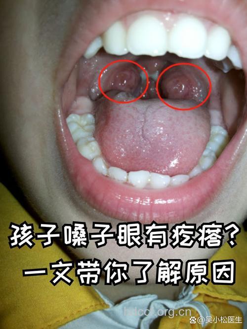 咽炎的早期症状是什么呢