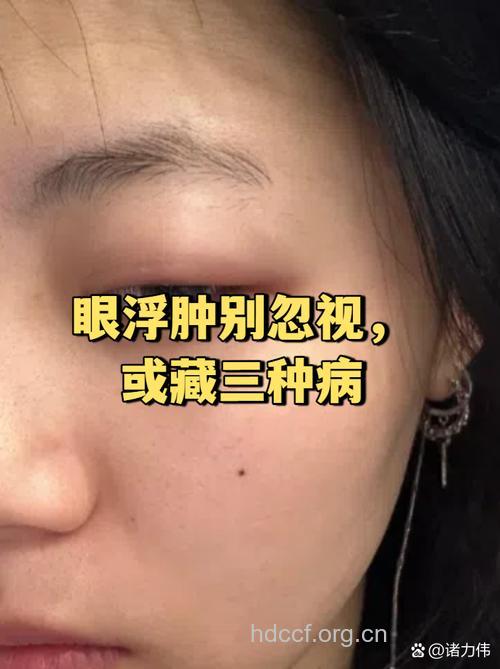 眼睛浮肿就一定是肾炎吗