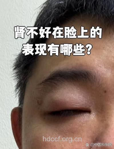 眼睑浮肿就是肾炎吗