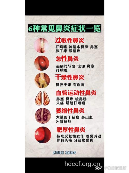 鼻炎的详细症状是什么呢