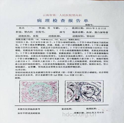 IgA肾炎的诊断依据