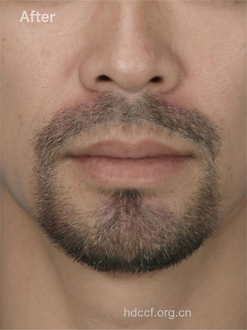 男性胡须生长越快生育力越强