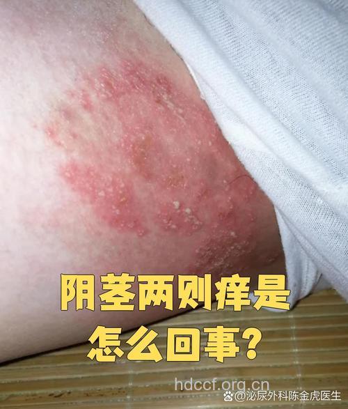 炎夏男人小心私密处皮肤病