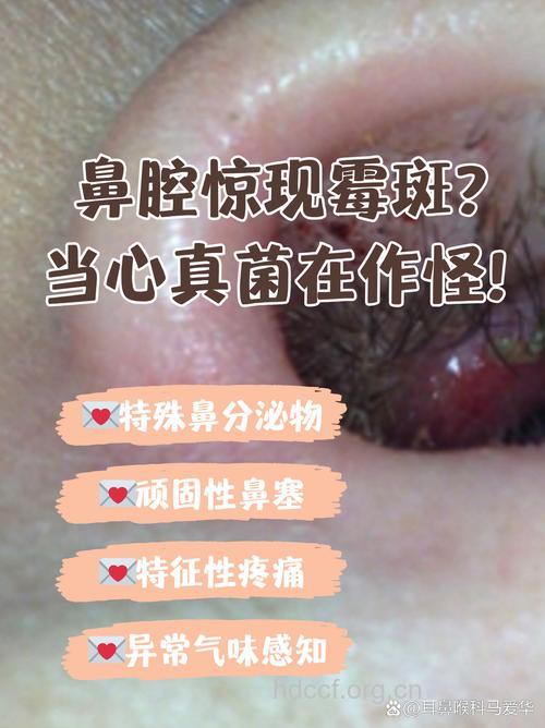 鼻子里面也会长霉菌？