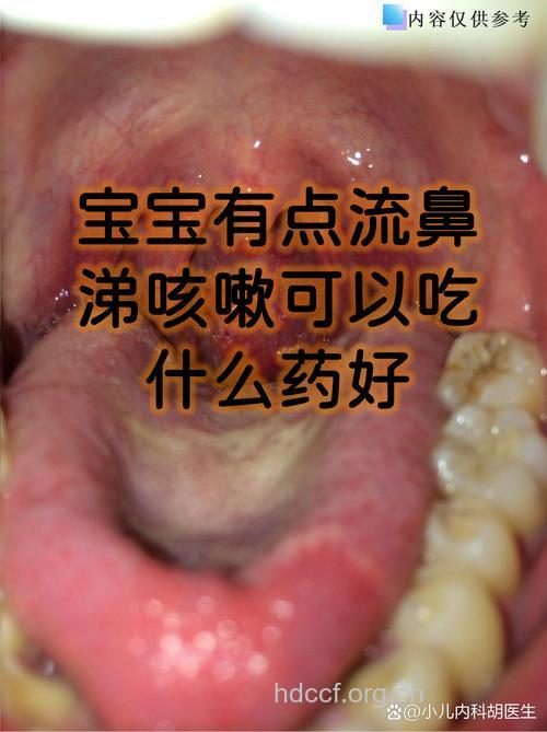 食积可导致鼻炎难愈