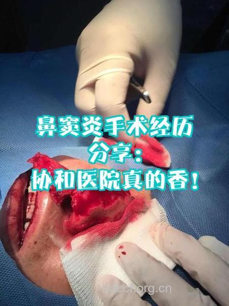 鼻窦炎患者首次手术需慎重