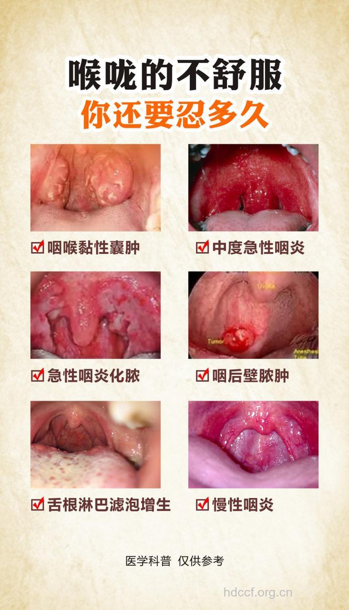 慢性咽炎患者 请看这