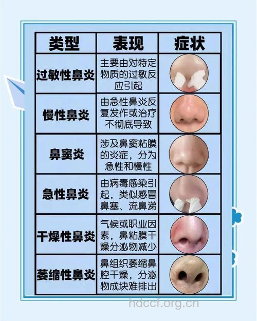 鼻炎症状及类型有哪些