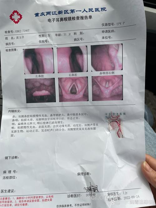 什么样的咽炎该去医院